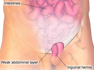 inguinal-hernia-female-3