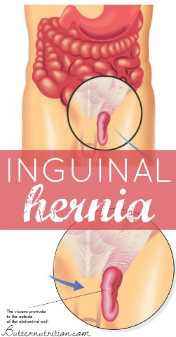 Surgery: Female Inguinal Hernia Repair | Butter Nutrition