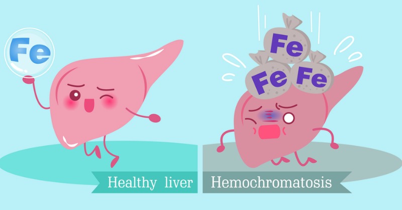 18 Signs of Hereditary Hemochromatosis and Iron Overload | Butter Nutrition